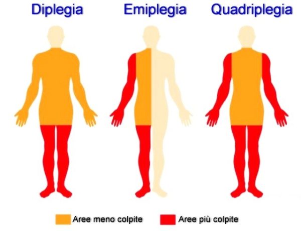 LA RIABILITAZIONE DEL PAZIENTE EMIPLEGICO